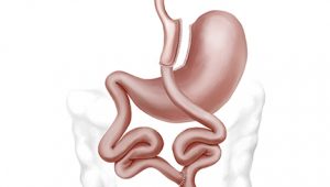 gastricbypass