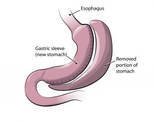 sleeve-gastrectomy